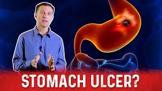 How To Get Rid Of Stomach Ulcer – DrBerg On Peptic Ulcer Treatment [upl. by Akenet571]