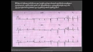 ეკგ  წინაგულების ფიბრილაცია და გულის ინფარქტი  დისპნოე და გულის არეში ტკივილი [upl. by Bivins]