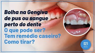 Bolha na Gengiva de pus ou sangue perto do dente O que pode ser Tem remédio caseiro Como tirar [upl. by Hatcher]