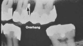 Dental Radiograph Pathology amp Restorations  Part I [upl. by Leimad]