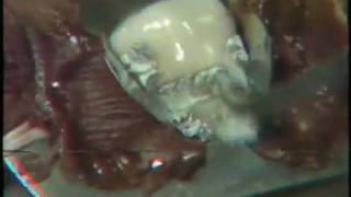 Class V Amalgam Restoration Cervical Matrix Application [upl. by Nohsauq732]