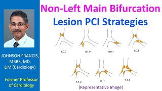 NonLeft Main Bifurcation Lesion PCI Strategies [upl. by Graf]