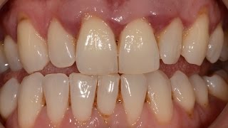 Treatment of Advanced Periodontal Gum Disease with Non surgical and Surgical Periodontal Therapy [upl. by Haikan]