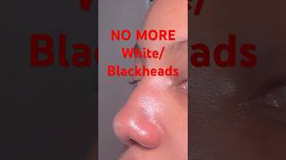 NO MORE WhiteBlackheads skincare [upl. by Baron785]