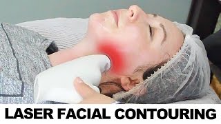 Laser Facial Contouring  Alma Accent Body and Face Contouring [upl. by Aicenert]