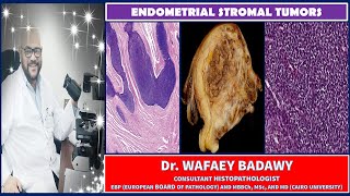 ENDOMETRIAL STROMAL TUMORS By Dr WAFAEY BADAWY [upl. by Atsirt]