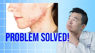 Clear Acne With Benzoyl Peroxide Pros and Cons [upl. by Rorry151]