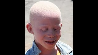 Albinism Causes Diagnosis and Treatment [upl. by Pat]