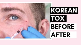 Korean Botulinum Toxin Before amp After  How To Dilute Toxins And Use For Forehead And Crow’s Feet [upl. by Aronel]