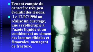 Hémangioendothéliome épithélioïde multifocal du membre inférieur [upl. by Vassar]