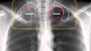 Pancoast Tumor amp Horner Syndrome [upl. by Arimahs]