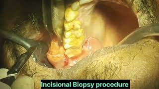 oral cancer kaise hota hai⚫️Incisional biopsy procedure⚫️ [upl. by Gunn]