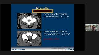 Unilateral hemilaminectomy for bilateral decompression in cervical spondylotic myelopathy [upl. by Drwde66]