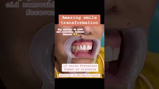 Porcelain Fused ti zirconia bridge  Dr Mae Abella Dental Clinic [upl. by Pavlish]