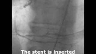 What A Diffenence A Stent Makes [upl. by Ades]