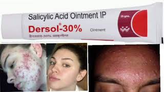 Dersol 30 Ointment Salicylic Acid Ointment IP [upl. by Ahsap]