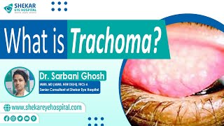 Symptoms amp Causes of Trachoma  Treatments and Stages of Trachoma  Shekar Eye Hospital Bangalore [upl. by Asim759]