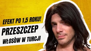 Przeszczep Włosów Turcja  efekt po 12 miesiącach [upl. by Attenor342]