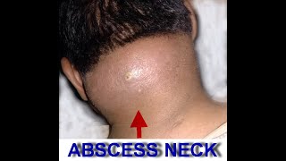 NECK ABSCESS 1 [upl. by Detta]