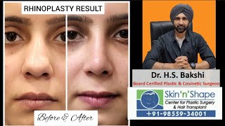 Transformed Confidence My Journey to a Beautiful New Nose  Bulbous Tip Success  Dr HS Bakshi [upl. by Noemi]