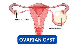 Ovarian Cyst  Removing Painful Ovarian Cysts Surgery Exposed  HealthAll12 [upl. by Truscott974]