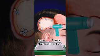 Craniectomy brain surgery  3D animationBrain Tumor Removalasmr animation viral [upl. by Brandon]