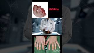 Chilblains Swelling in hands and feet [upl. by Nalehp]