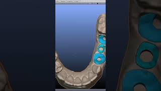 surgical guide with custom healing abutmentexocad b4d blender surgicalguide dubai explore [upl. by Aek253]