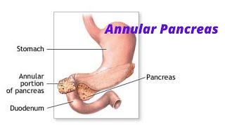 Annular Pancreas fmge neetpg usmle [upl. by Reseta502]