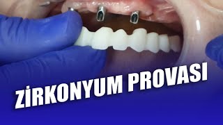 Zirkonyum Provası Nasıl Yapılır İmplant Üstü Zirkonyum Kaplama Provası [upl. by Reizarf]