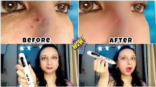 How to remove mole using mole remover pen  best product to make your skin clear mole skin viral [upl. by Leik]