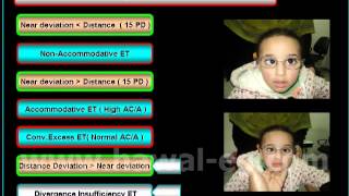 Strabismus Esotropia According to NearDistance Disparity [upl. by Aggie]