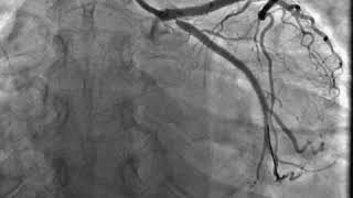 In stent restenosis of OSTIAL LCX [upl. by Eidur]