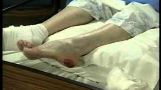 Pressure Ulcers  Soft Tissue Compression  Wound Care Education [upl. by Ahsinid955]