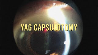 YAG CAPSULOTOMY TAKE A LOOK TO THE TECHNIQUE [upl. by Attelrahc950]