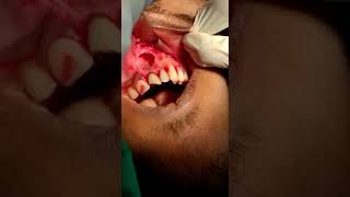 Maxillary cyst Removal jaw cyst Removal Radicular cyst Enucleation [upl. by Erickson]