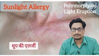 धूप की एलर्जी  Sunlight Allergy  Light Allergy  Polymorphous Light Eruption Sun Allergy allergy [upl. by Nlocnil]