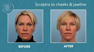 Sculptra filler for cheeks and jawline [upl. by Lachus]