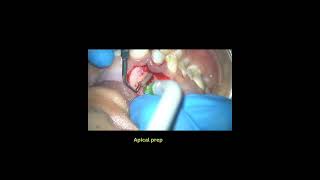 Apicectomy with radicular cyst removal and retreatment [upl. by Laure]