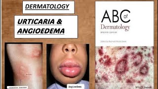 DERMATOLOGY  URTICARIA amp ANGIOEDEMA derma urticaria angioedema [upl. by Urbani288]