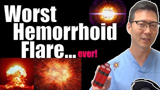 The WORST type of hemorrhoid flare and what to do  Internal hemorrhoid thrombosis [upl. by Anedal]