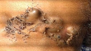 Mangos Nevus Comedonicus Spreading Blackheads [upl. by Asselam]