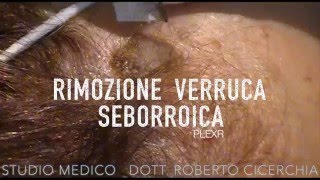 Rimozione Cheratosi con PLEXR  Dott Roberto Cicerchia [upl. by Hubing]