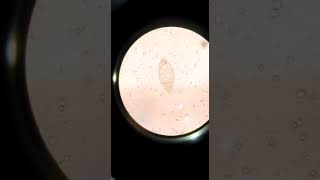 How Schistosoma Haematobium Ova in Urine Microscopy appears [upl. by Drageruaeb210]