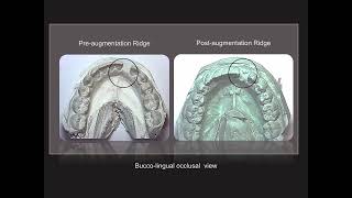 Ridge augmentation with BMP2  26 with implant placement [upl. by Ayaj]