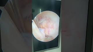 ACL ganglion cystkeyhole surgery arthroscopic decompression kneearthroscopy acl ganglioncyst [upl. by Ramu371]