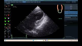 IQ 306 AFI LA ECHOPAC ANALYSIS HEPATOMA PTE ECHOCARDIOGRAPHY [upl. by Boony]