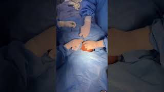 Femoral Line Insertion Before Craniofacial Hyperteleroism Correction [upl. by Eillehs]