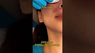 CO2 Laser Changed My Skin😱 acne acnescars beauty [upl. by Bakeman943]