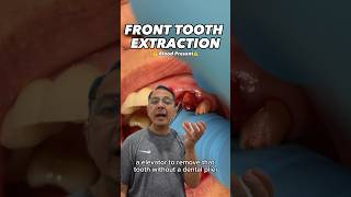 Broken Front Tooth Extraction EXPLAINED  View Mobile Dental shorts [upl. by Namreg517]